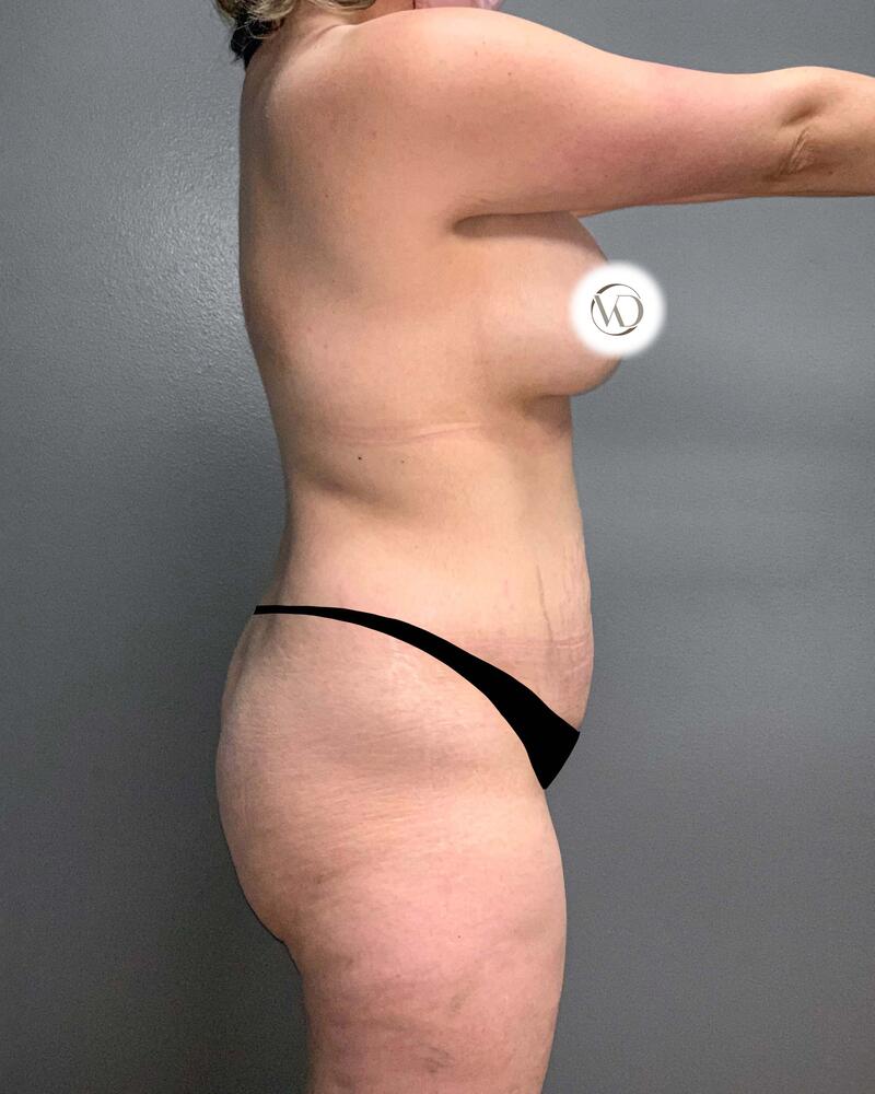 Tummy Tuck Before & After Image