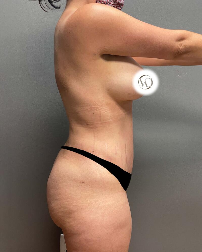 Tummy Tuck Before & After Image