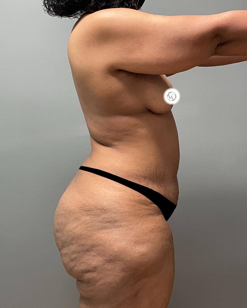 Tummy Tuck Before & After Image