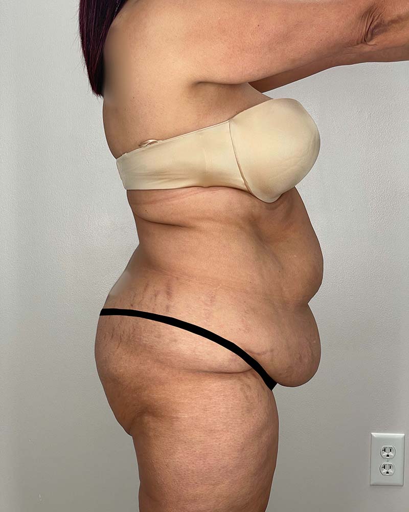 Tummy Tuck Before & After Image