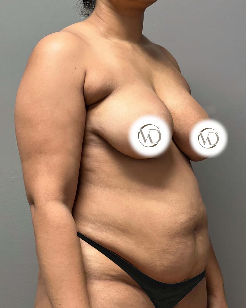 Tummy Tuck Before & After Image