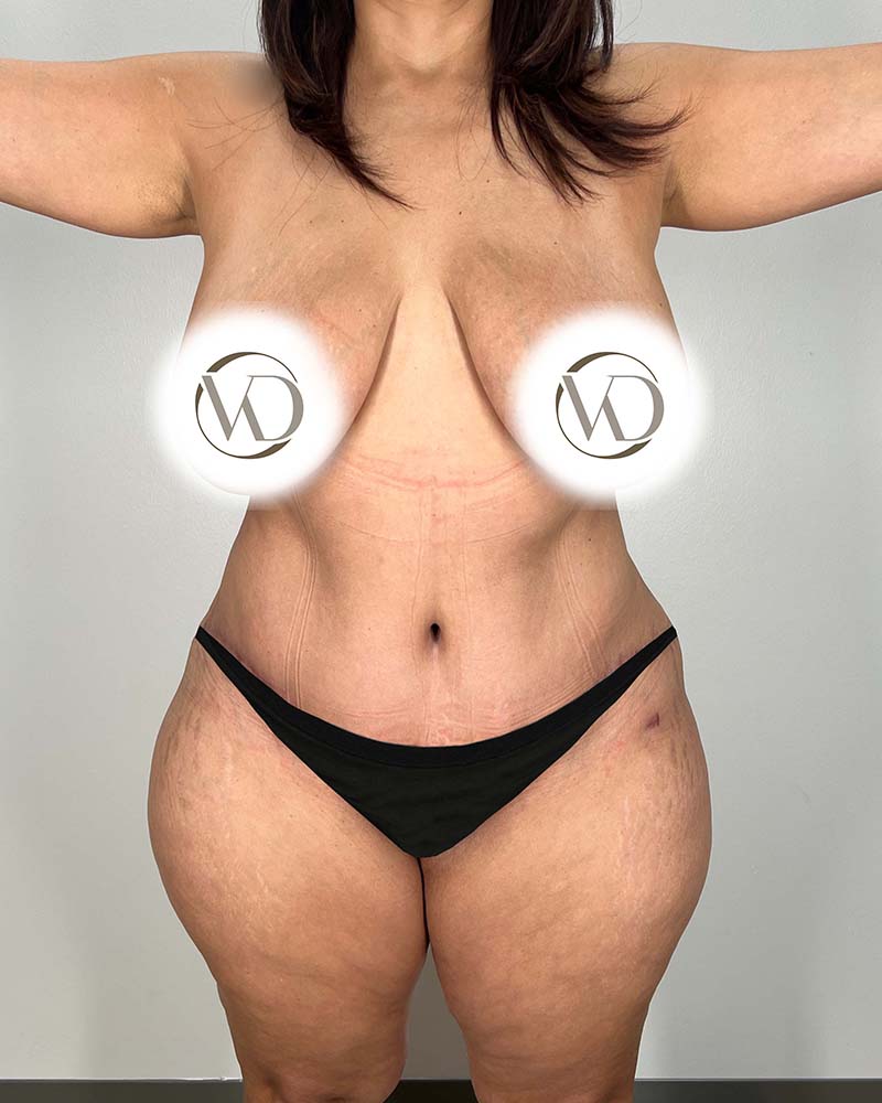 Sculptra Before & After Image