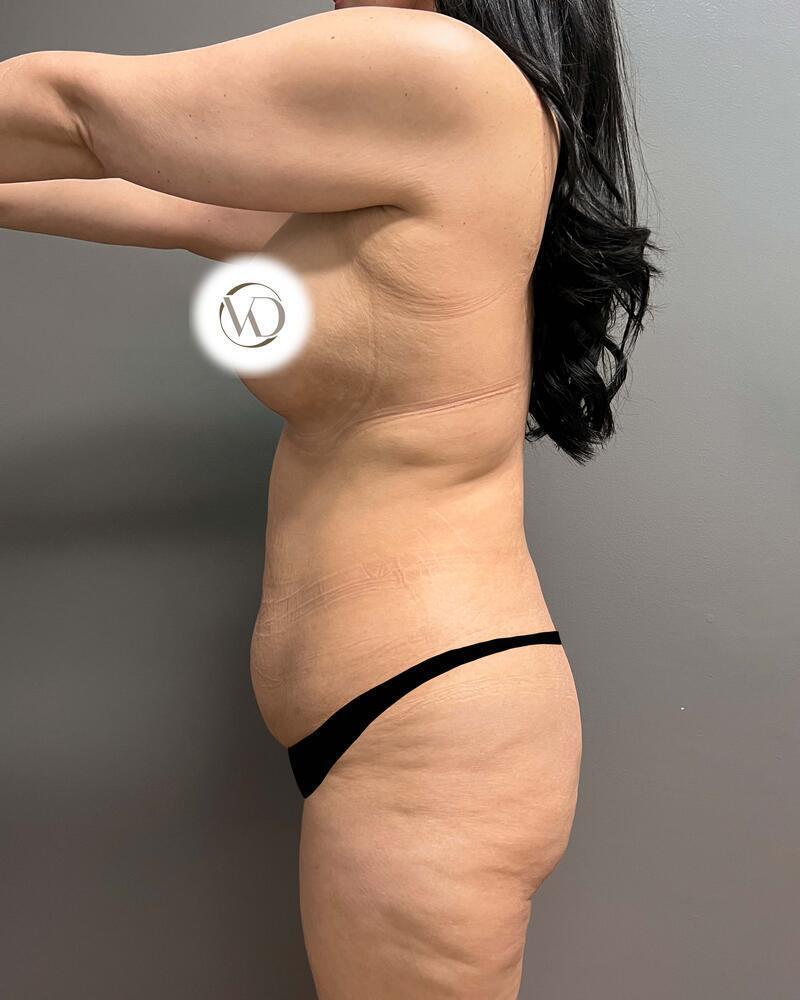 Tummy Tuck Before & After Image