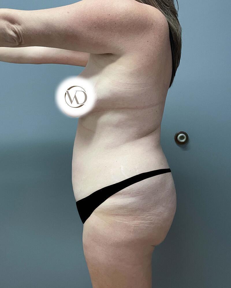 Tummy Tuck Before & After Image