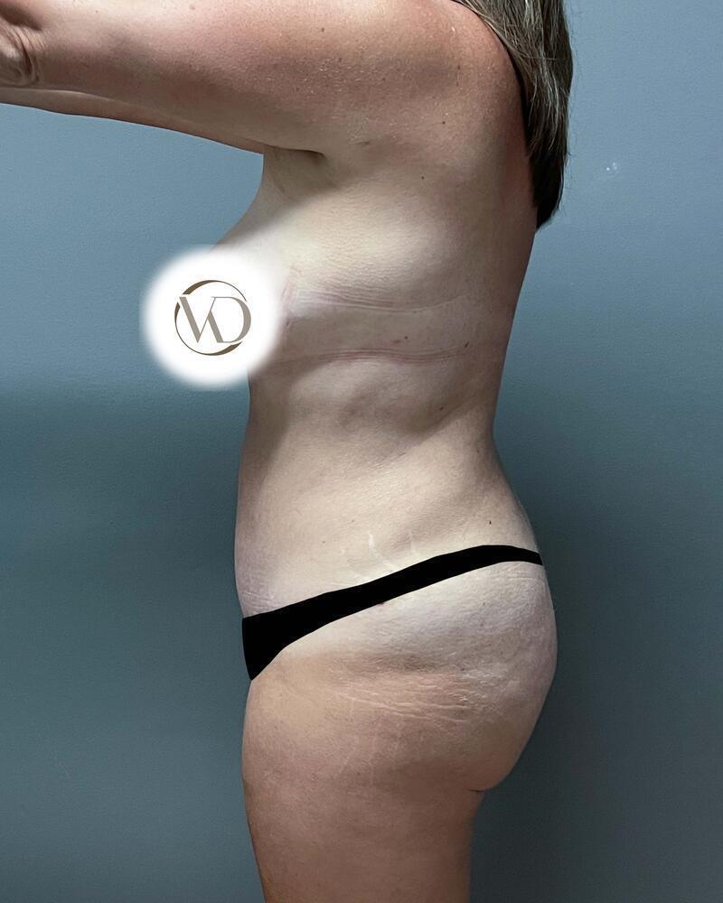 Tummy Tuck Before & After Image
