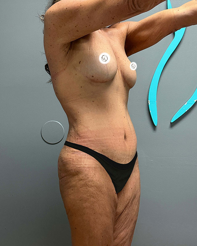Tummy Tuck Before & After Image