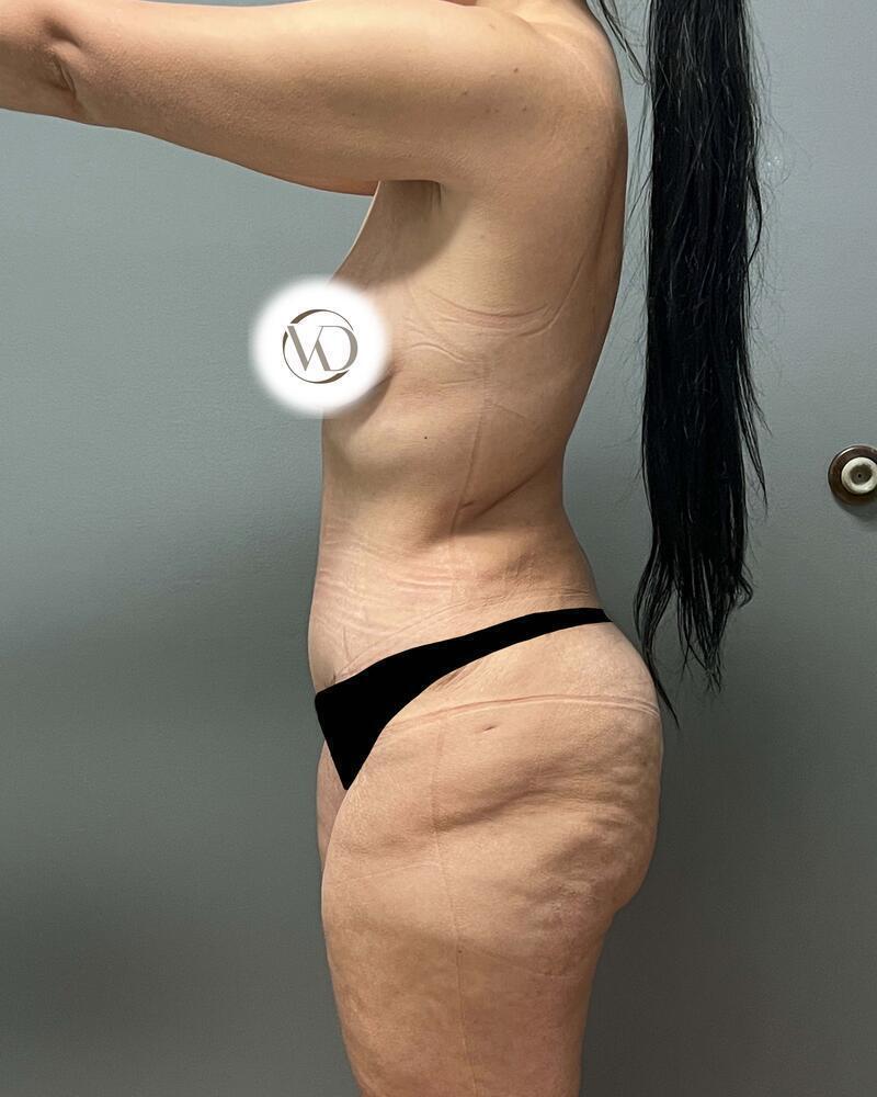 Tummy Tuck Before & After Image