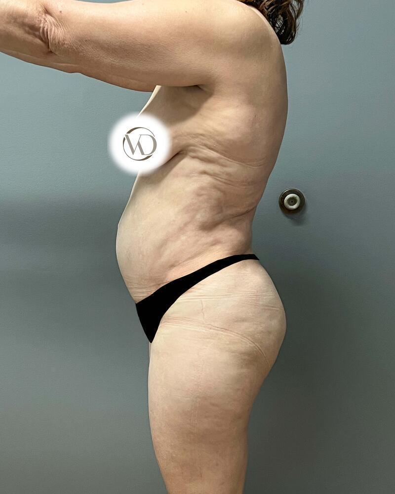 Tummy Tuck Before & After Image
