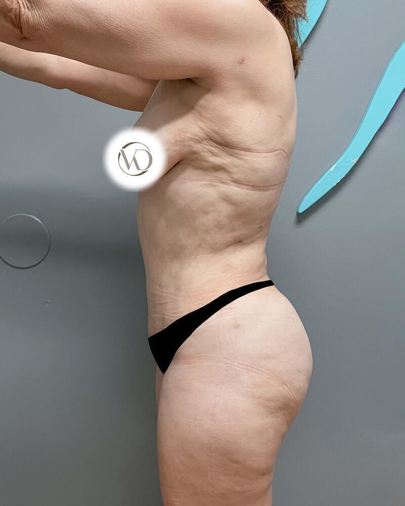 Tummy Tuck Before & After Image