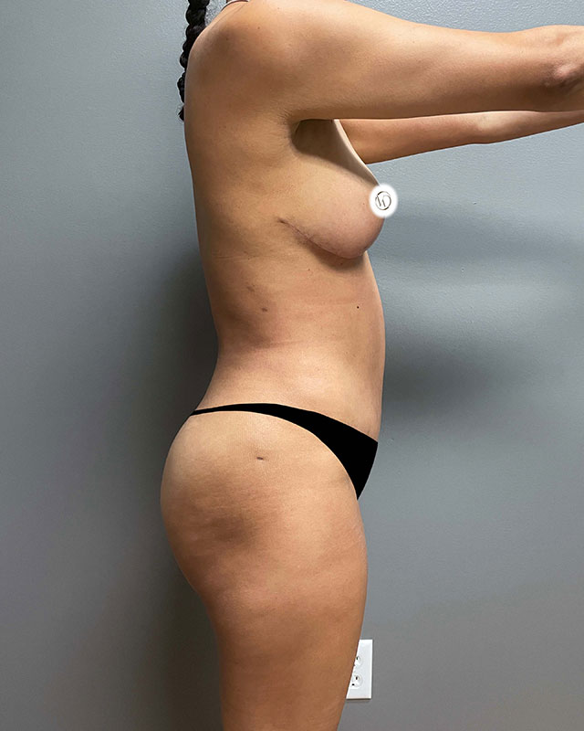 Tummy Tuck Before & After Image