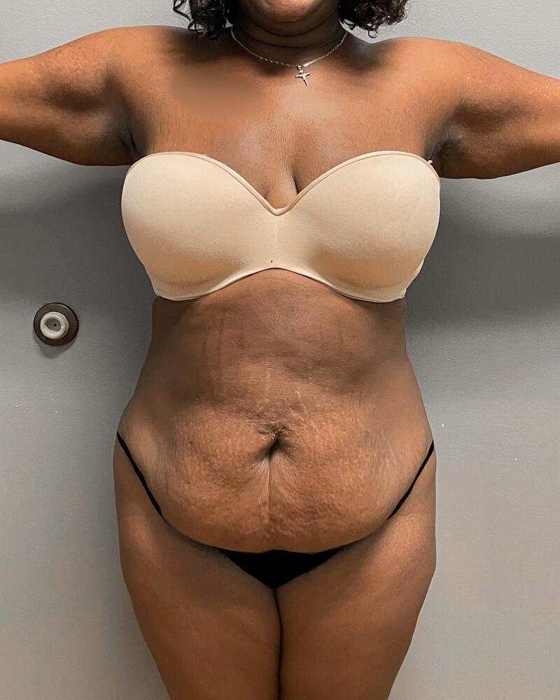 Sculptra Before & After Image