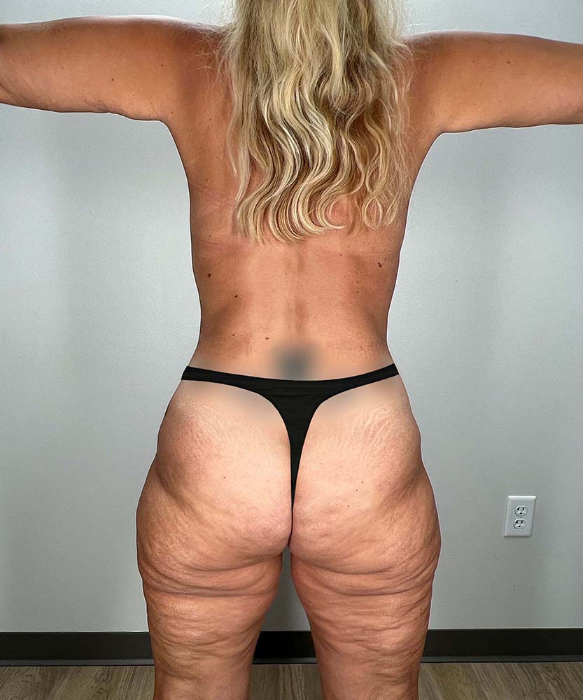 Tummy Tuck Before & After Image