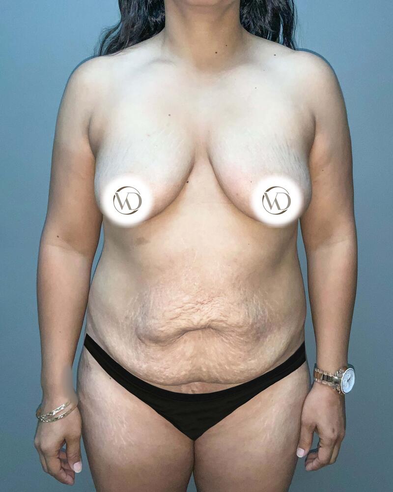 Sculptra Before & After Image