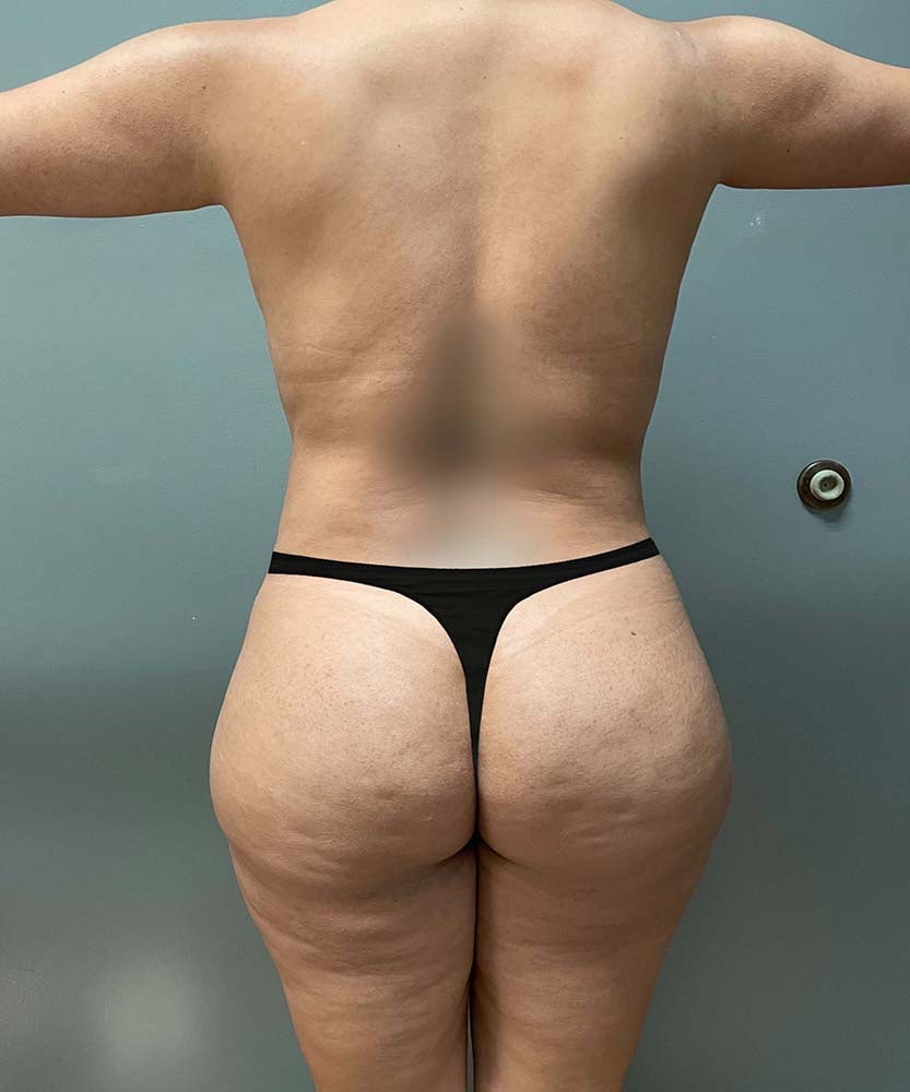 Tummy Tuck Before & After Image