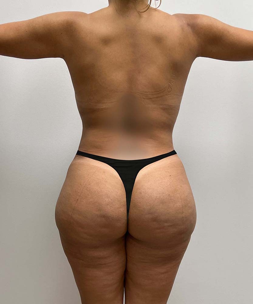 Tummy Tuck Before & After Image