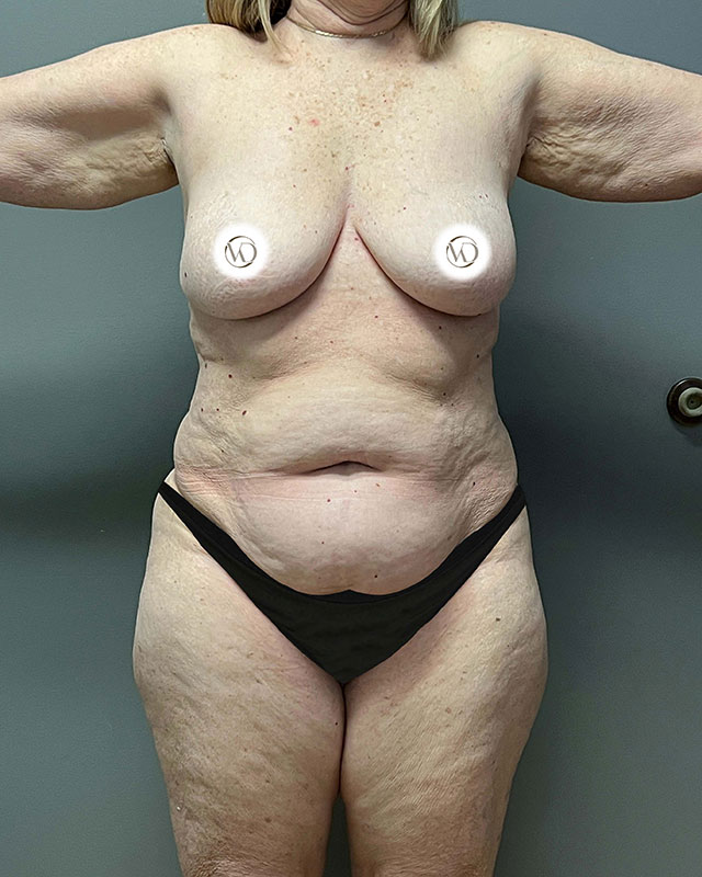 Sculptra Before & After Image