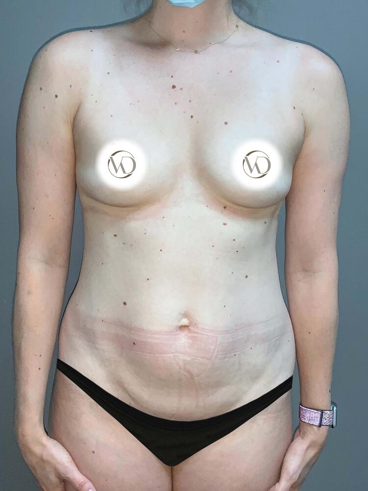 Sculptra Before & After Image