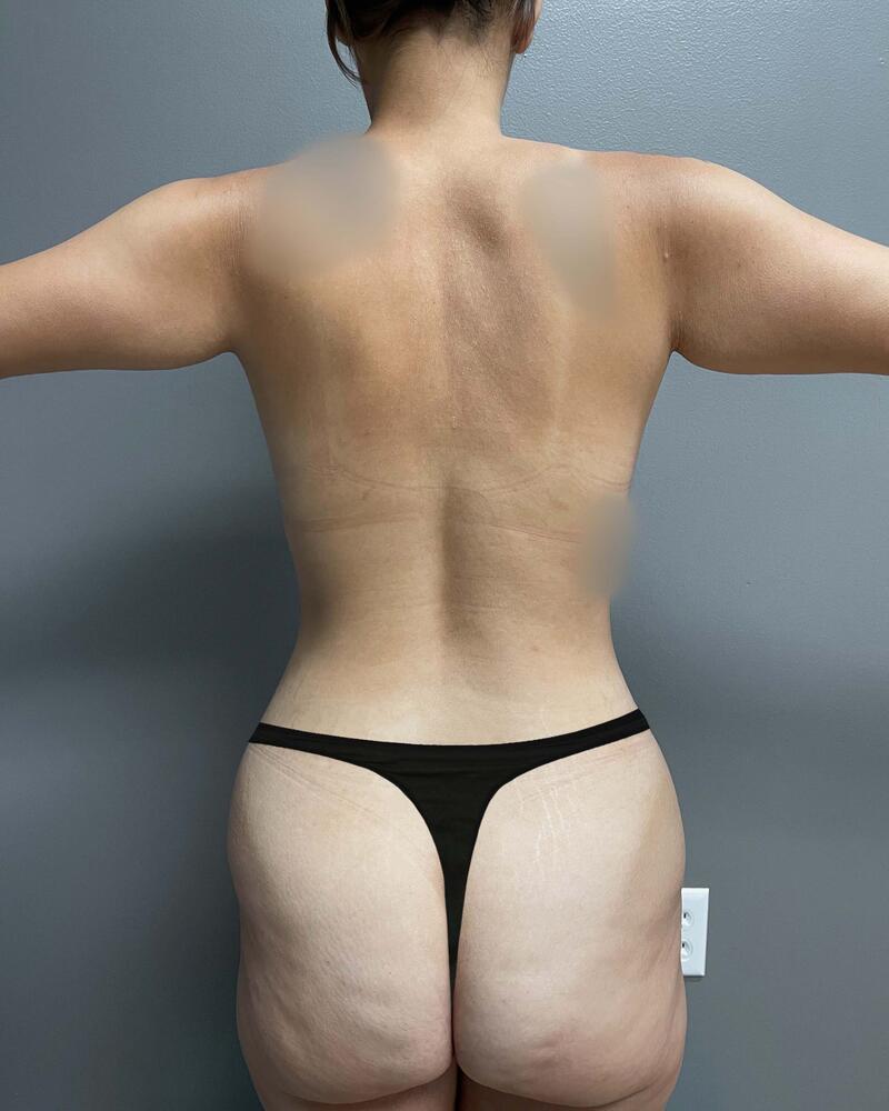 Tummy Tuck Before & After Image