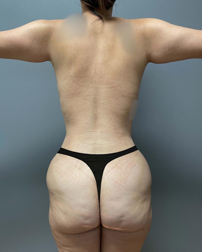 Tummy Tuck Before & After Image