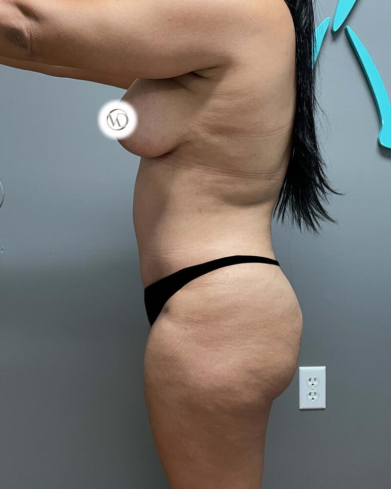 Tummy Tuck Before & After Image