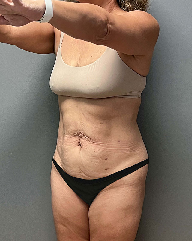 Tummy Tuck Before & After Image