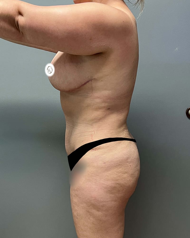 Tummy Tuck Before & After Image