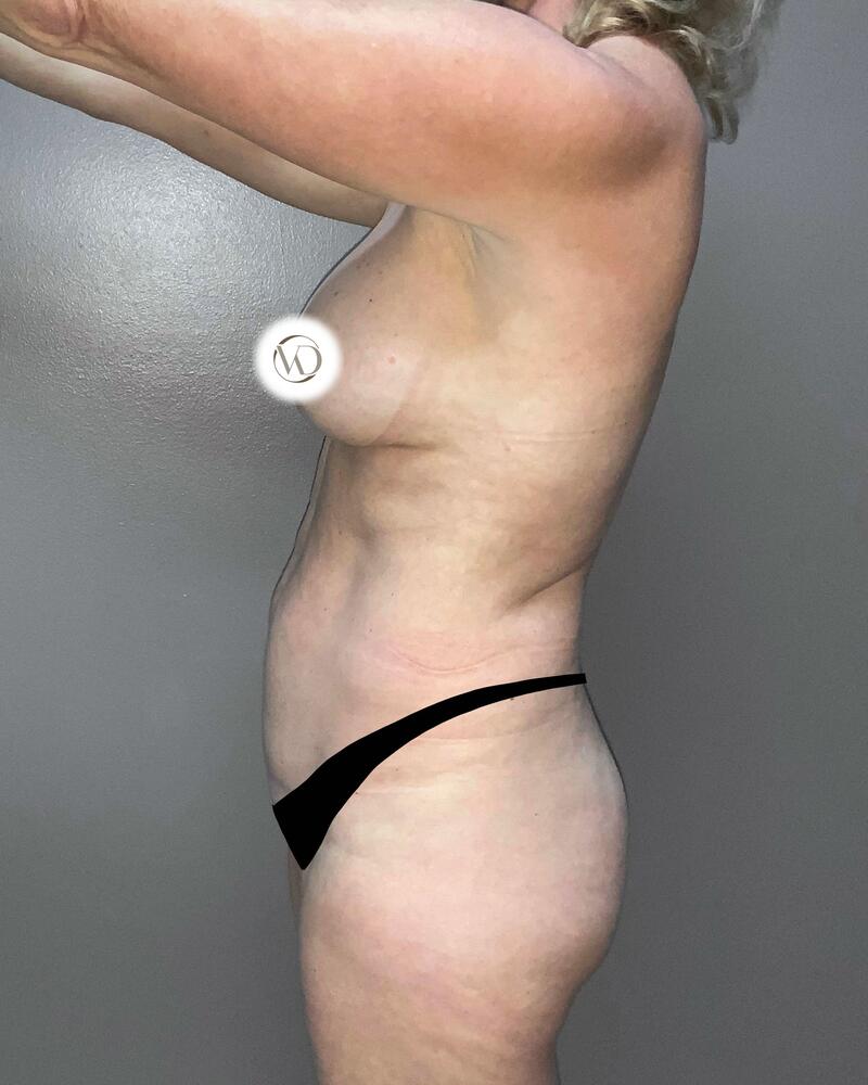 Tummy Tuck Before & After Image