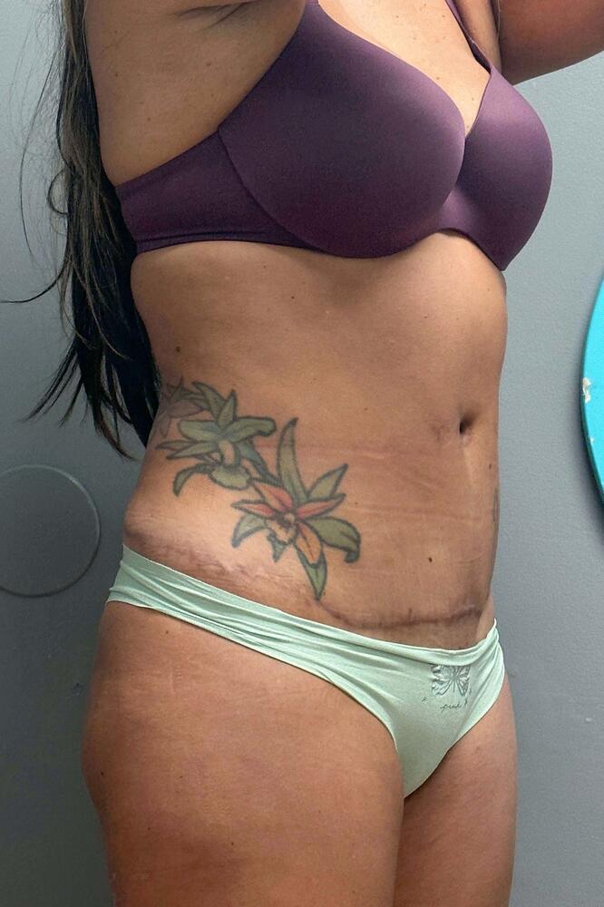 Umbilicoplasty Before & After Image