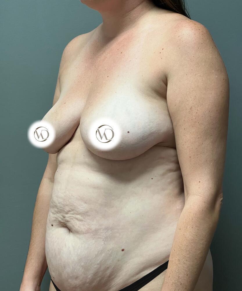 Breast Augmentation Before & After Image