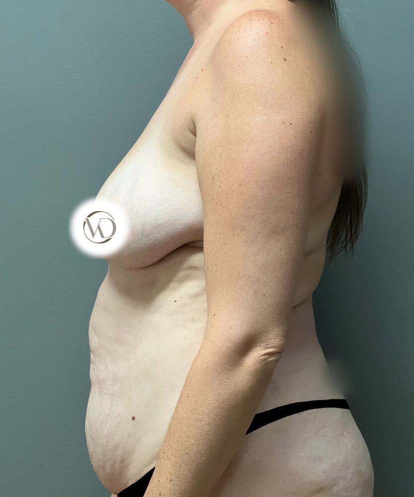 Breast Augmentation Before & After Image