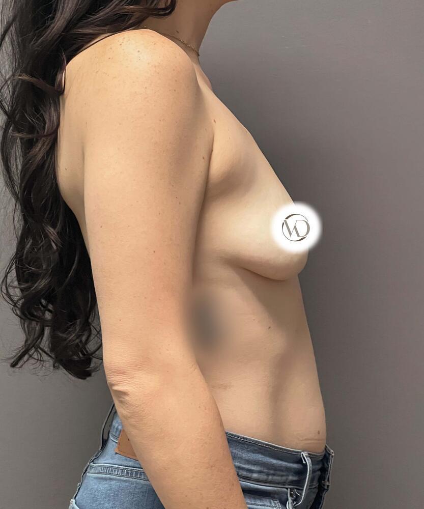 Breast Augmentation Before & After Image