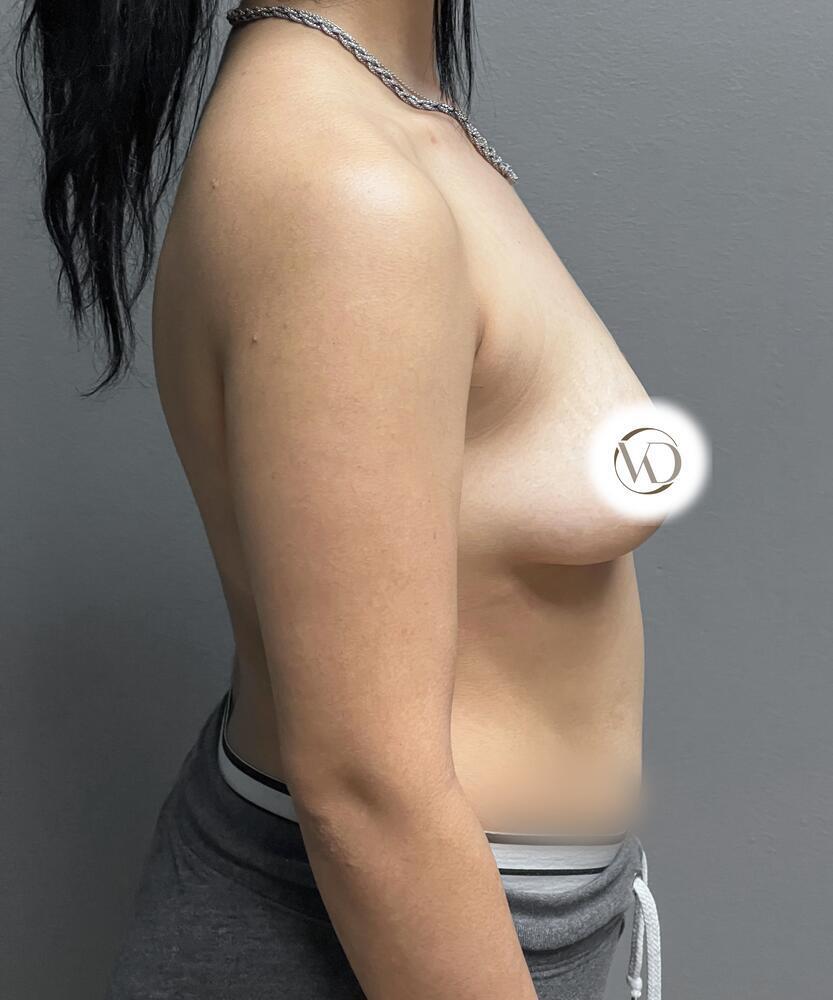 Breast Augmentation Before & After Image