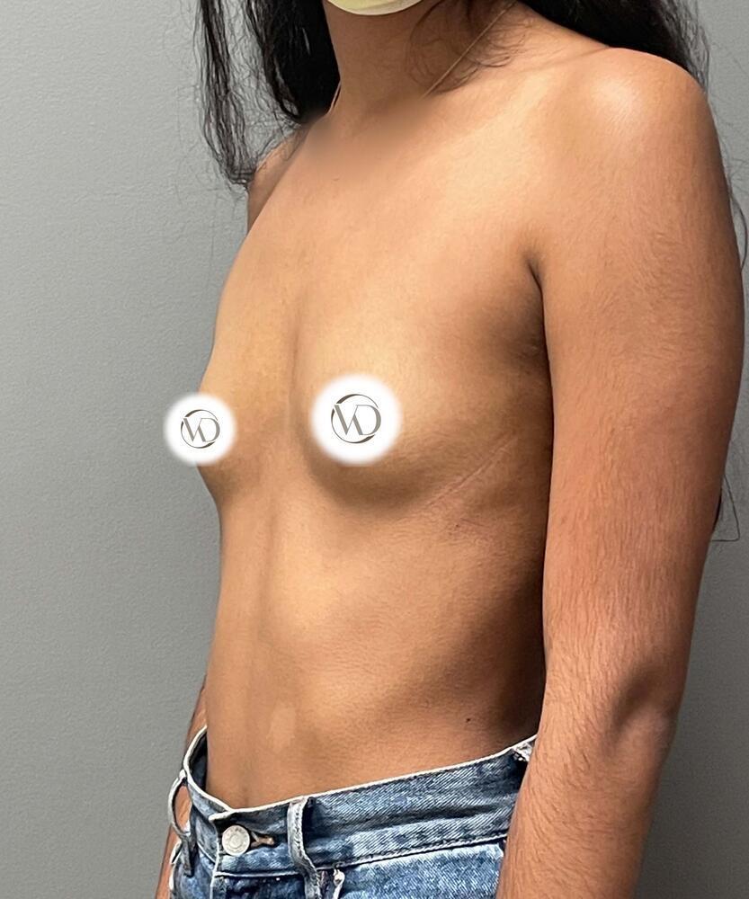 Breast Augmentation Before & After Image