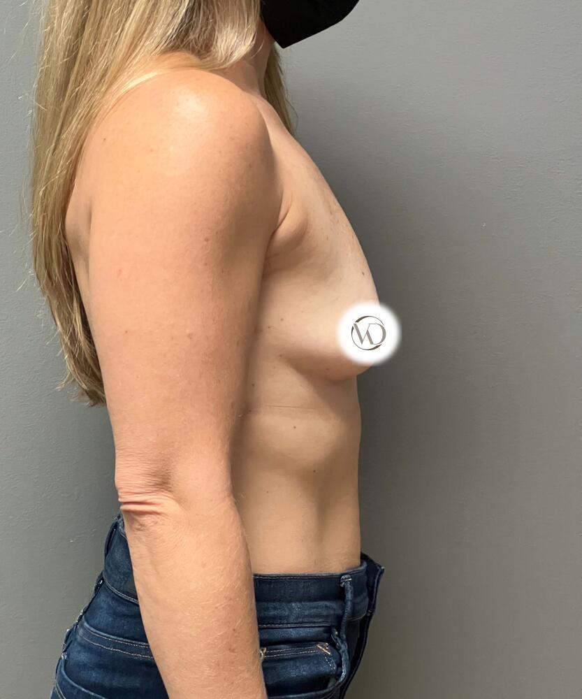 Breast Augmentation Before & After Image