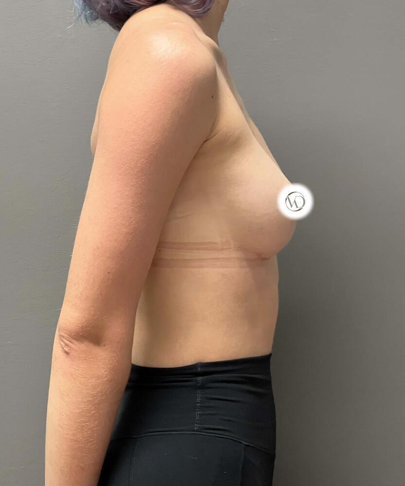 Breast Augmentation Before & After Image