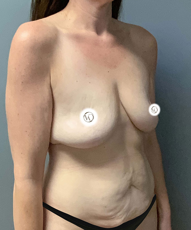 Breast Augmentation Before & After Image