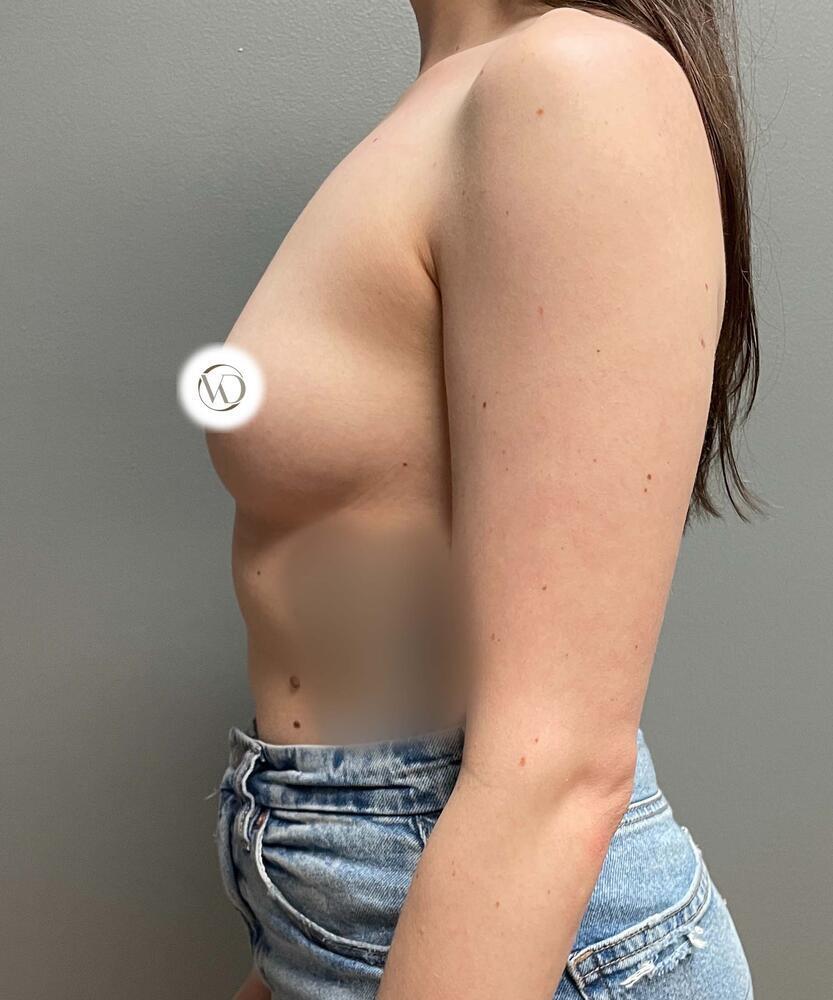 Breast Augmentation Before & After Image