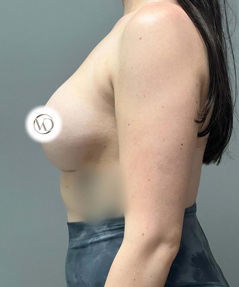 Breast Augmentation Before & After Image