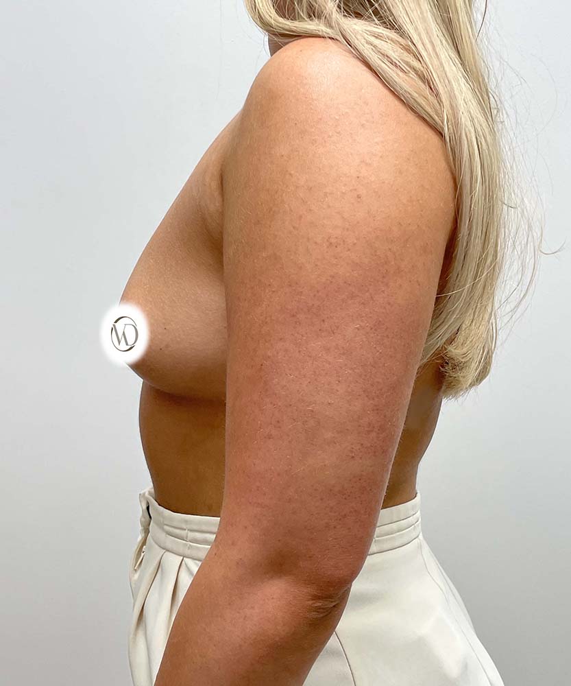 Breast Augmentation Before & After Image