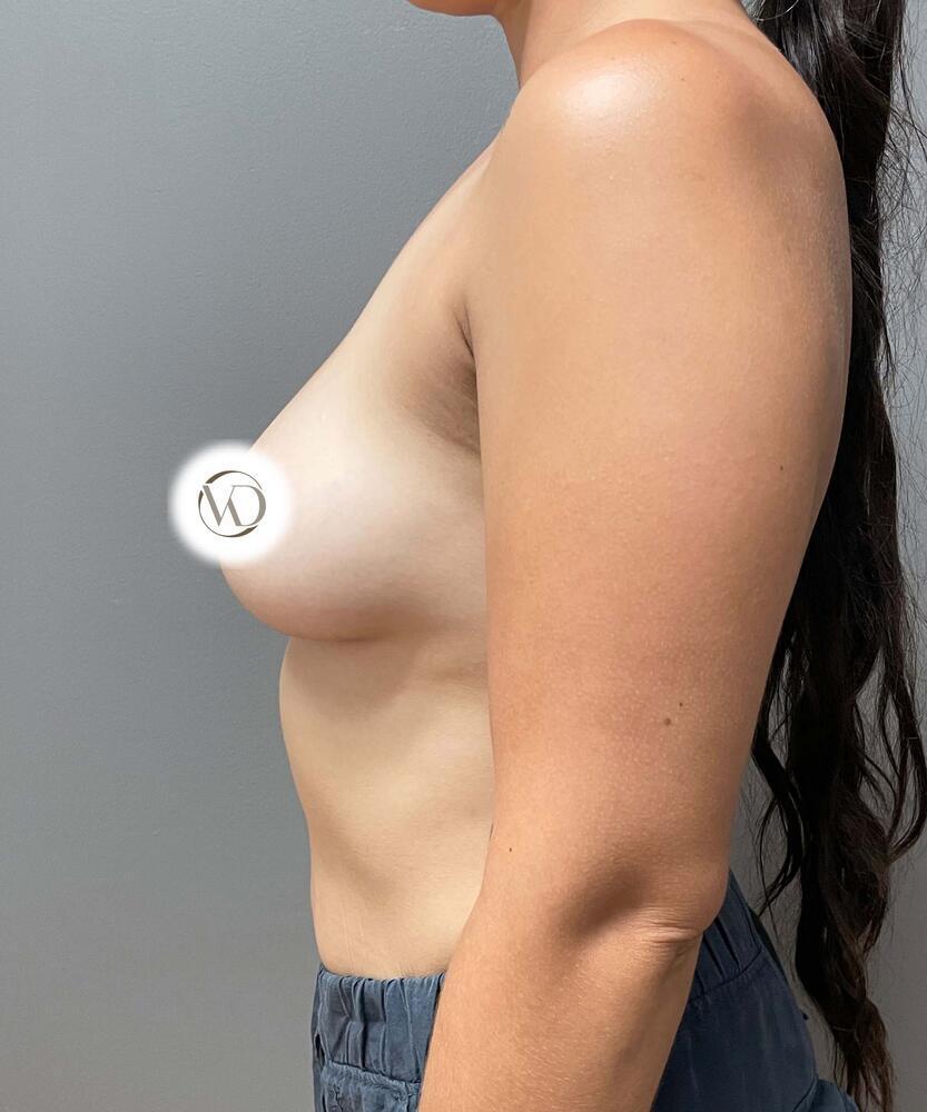 Breast Augmentation Before & After Image