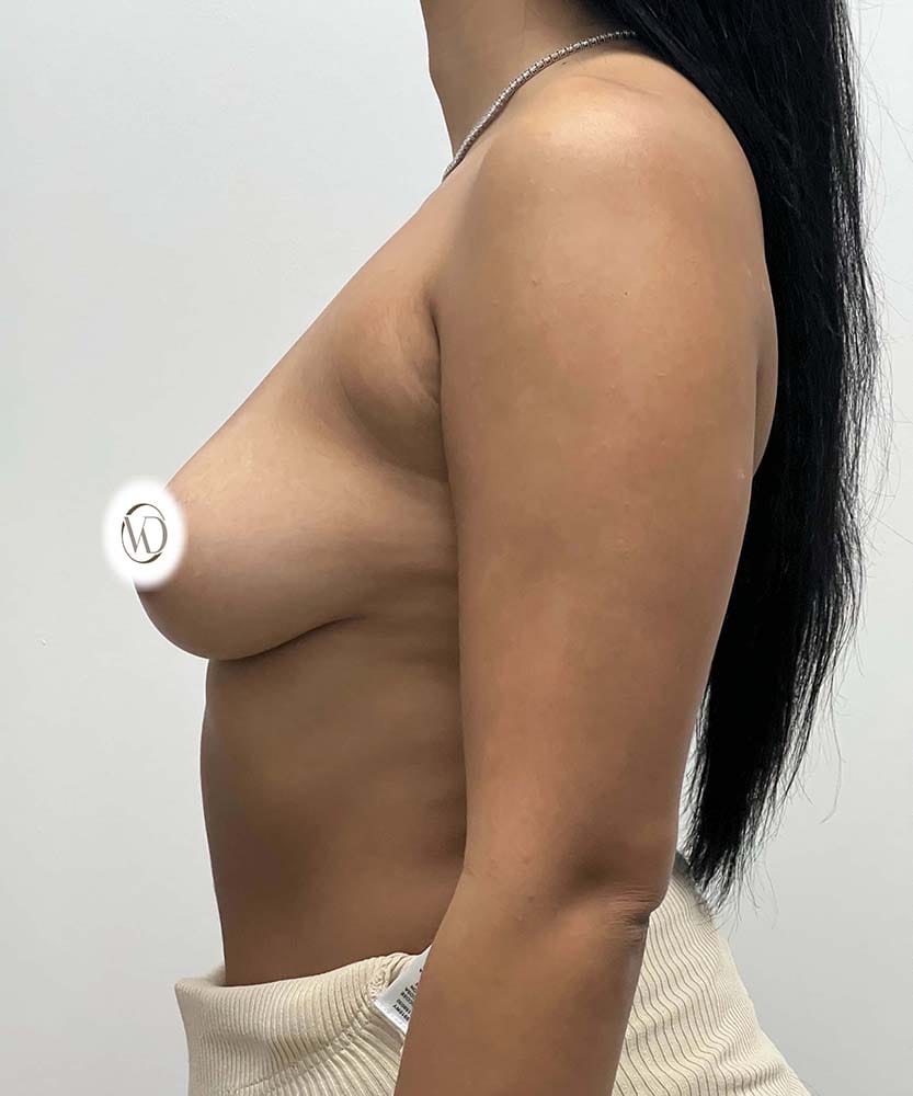 Breast Augmentation Before & After Image