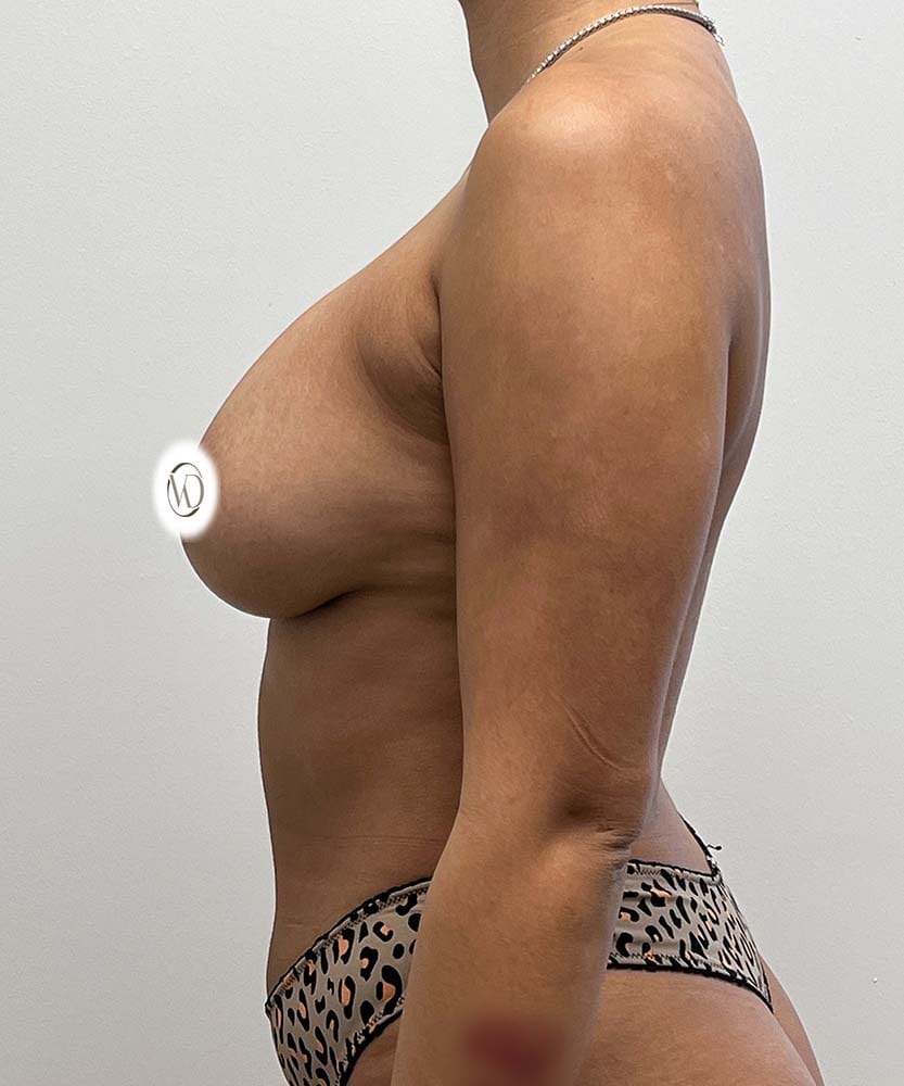 Breast Augmentation Before & After Image