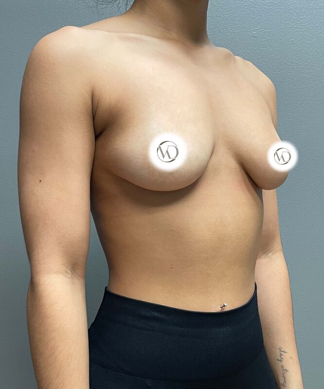 Breast Augmentation Before & After Image