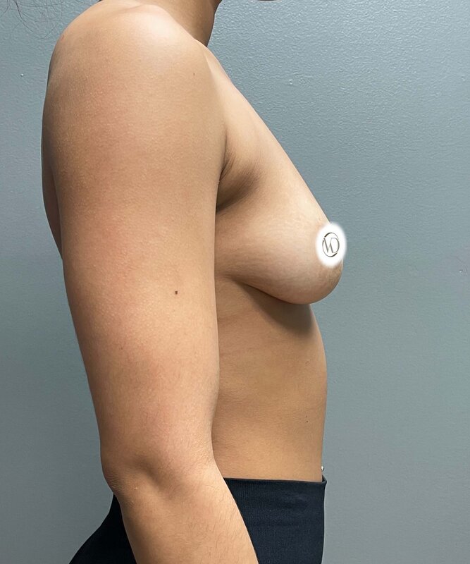 Breast Augmentation Before & After Image