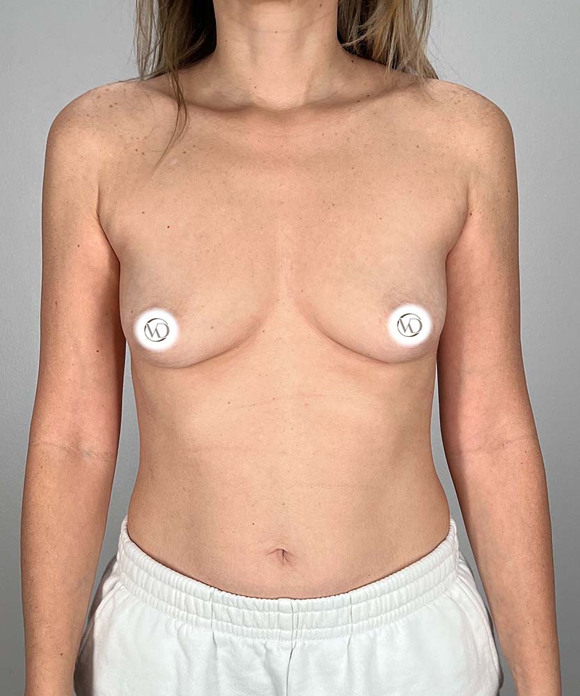 Breast Augmentation Before & After Image