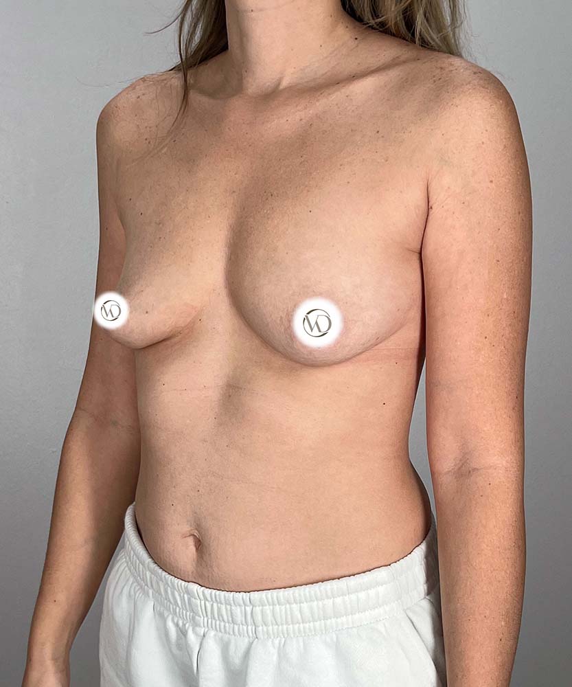 Breast Augmentation Before & After Image