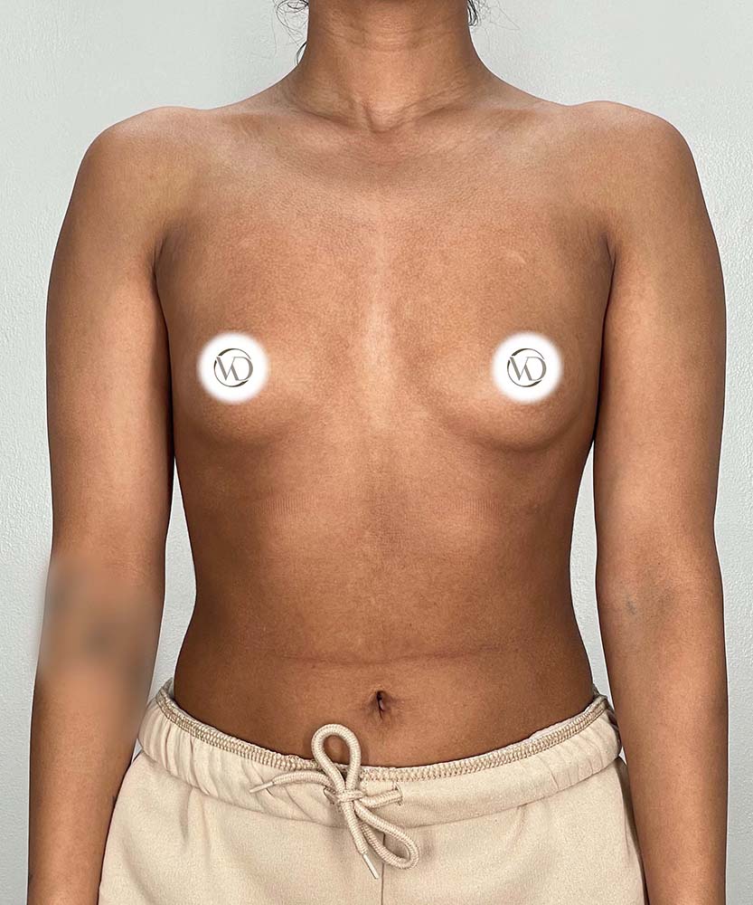 Breast Augmentation Before & After Image