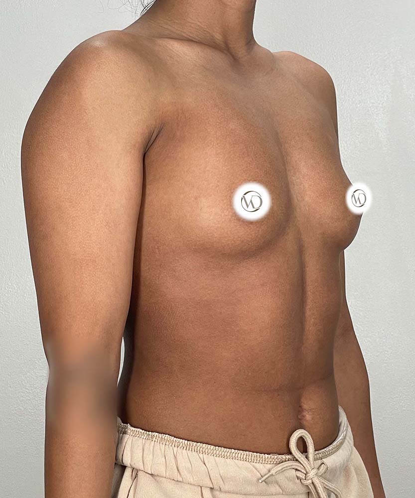 Breast Augmentation Before & After Image