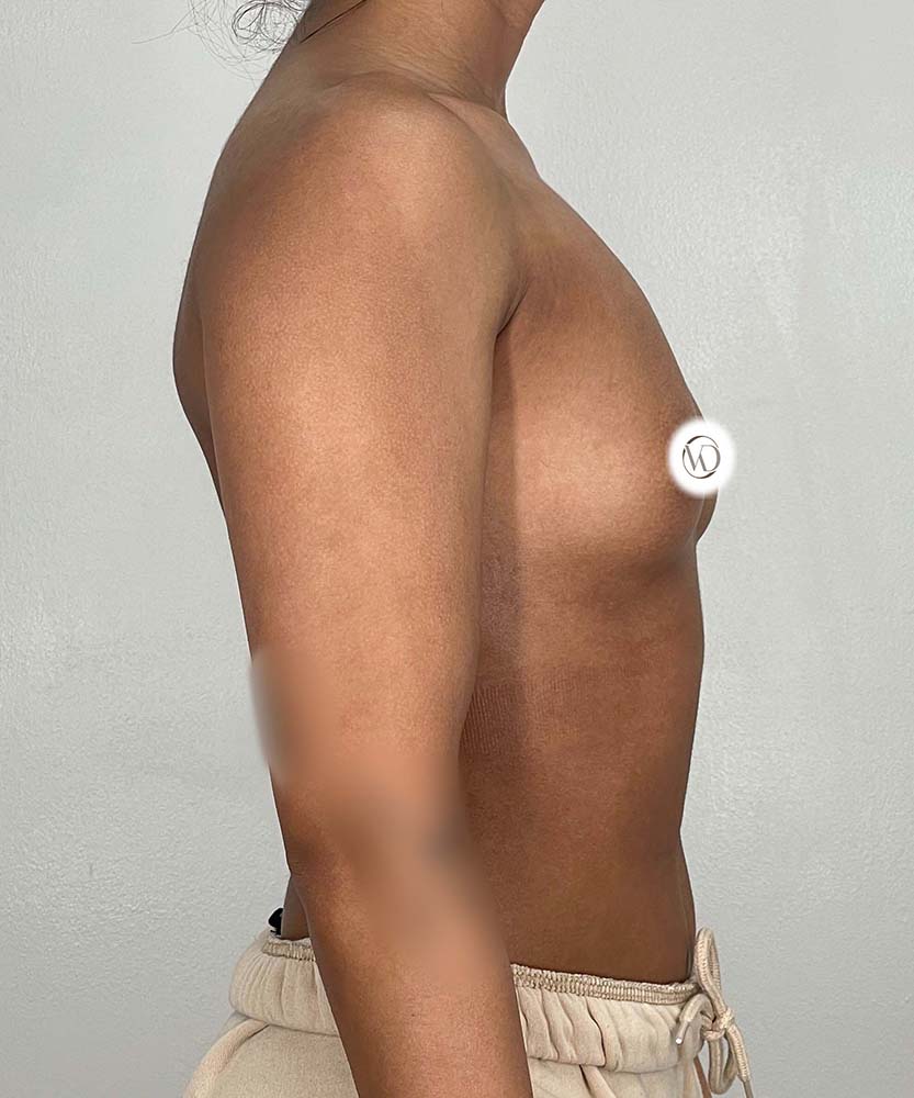 Breast Augmentation Before & After Image