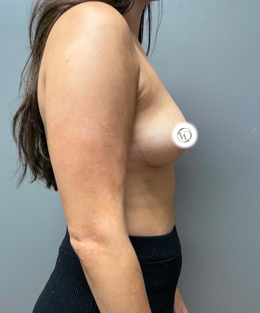 Breast Augmentation Before & After Image